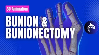 Bunion and Bunionectomy with Osteotomy - 3D Animation