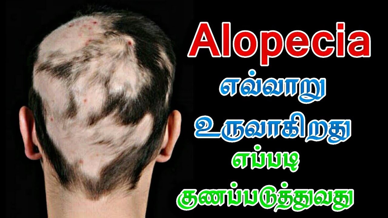 natural treatment for asthma தலையில் பூச்சிவெட்டு நீங்க | தலையில் புழுவெட்டு நீங்க | How to cure Alopecia natural way