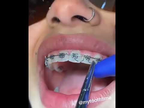 Orthodontic Goodman Torquing Spring Placement - YouTube
