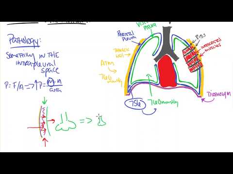 Pneumothorax