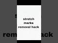 stretch marks removal hack !! #beautytips #selfcare #skincare #shortsfeed
