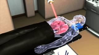 Lung Tumor Treatment Animation - Spokane CyberKnife
