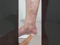 Varikoz damar lazer emeliyyatindan evvel ve 2 hefte sonra Lazerle damar mualicesi doposle 2 hefte
