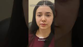Kaili's Rhinoplasty Results