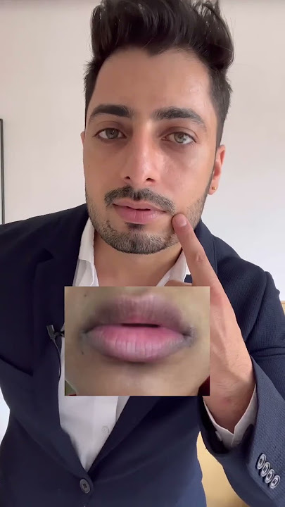 Do you have cracked lip corners?