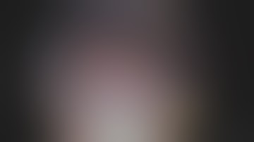 Laparoscopic Liver Resection (Segment 3 Liver Tumor) for Colon Cancer Liver Metastasis