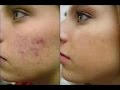 Remove acne and get great skin 