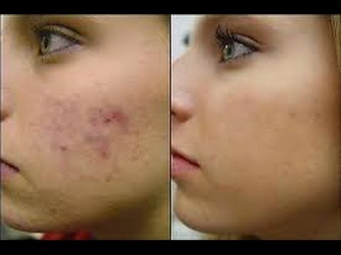 Images search for a recipe to remove acne result