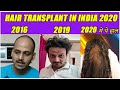 Hair transplant 3 years result | सिर्फ 3 साल में ये क्या हो गया |