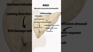 MASH/NASH -Nonalcoholic liver disease . #fattyliver, #nonalcoholicfattyliver,#mash,#nash