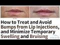 Treating and Avoiding Bumps from Lip Filler Injections, and Minimizing Swelling and Downtime