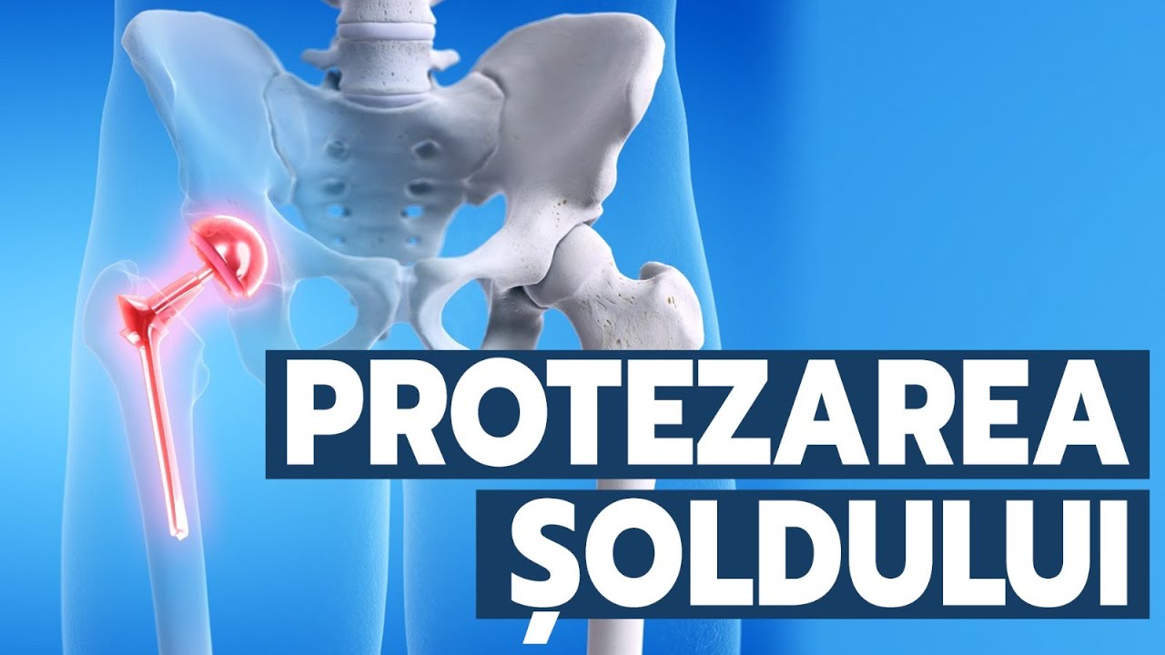 Protezarea șoldului: în ce constă și când se recomandă?