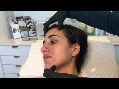 Dermapen Skin Needling for Acne & Scarring