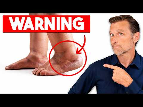 Thumbnail for Your Feet Are Warning You — Here’s What the Swelling Really Means