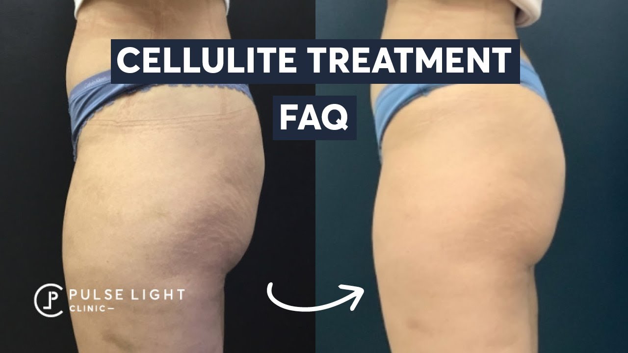 Cellulite Treatment FAQ: Do These Treatments Work?