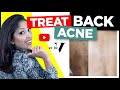 How To Treat Back Acne FAST | Doctors Tips | Skin of Colour Asian/Black | Treat Backne | DR V