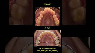 Orthodontic Treatment Before and After - Braces Smile Transformation @DentCareNepal