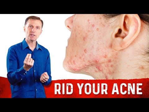 How to Get Rid of Acne Fast