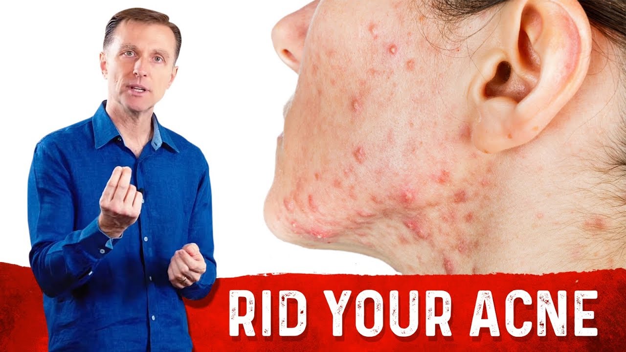 How To Get Rid Of Acne Fast Try Drbergs Home Remedies For Acne Youtube