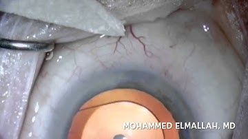 iStent: Aqueous Flow into the Episcleral Veins