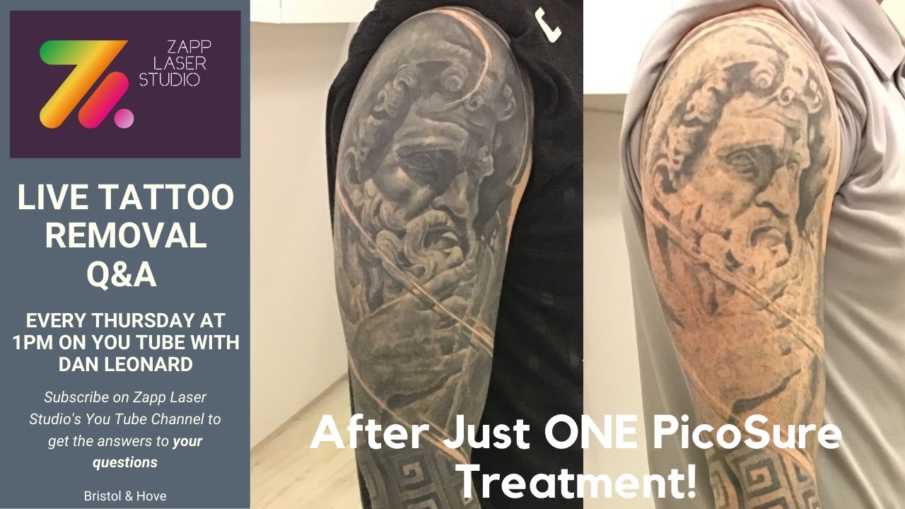 Sleeve Tattoo Gone in Just 4 Laser Sessions Before  After Photos New  Jersey  Reflections Center
