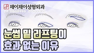 눈썹밑리프팅이 효과 없는 이유