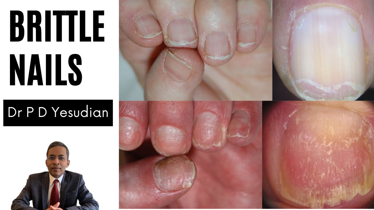 When Brittle Nails Lead to Broken Nails – Causes, Treatment and Preven –  Dr. Dana