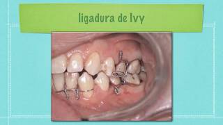 Ivy   Loop explanation