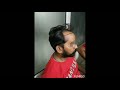 Result after 4 months regrowth hair transplant centre chamkaur sahib