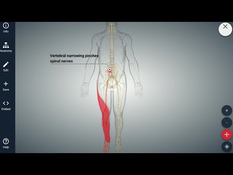 Video: Kanalų stenozę gali sukelti?