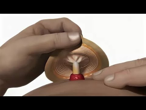 Тампон для купания со стомой - колостомой
