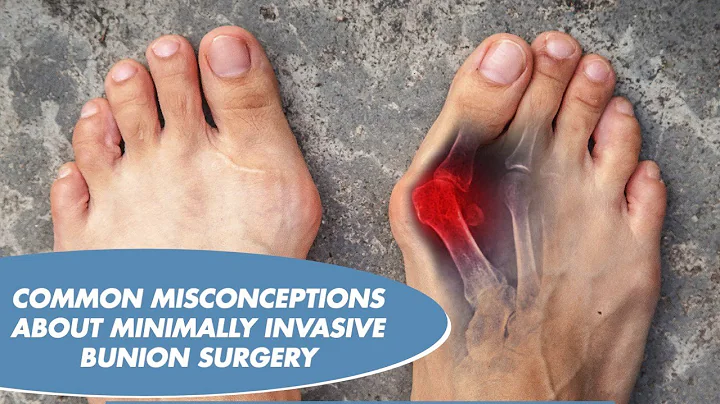 COMMON MISCONCEPTIONS ABOUT MINIMALLY INVASIVE BUNION SURGERY - DR. AMMAR SAYMEH
