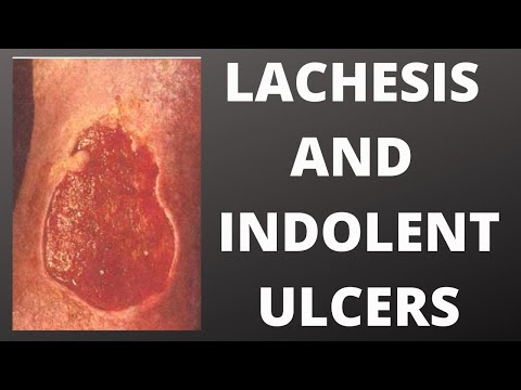 lachesis and indolent ulcers || homeopathic medicine for indolent ulcer !