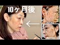 【シミ治療】シミ再発!?︎新たなシミ!?︎初シミ取りレーザーから10ヶ月後