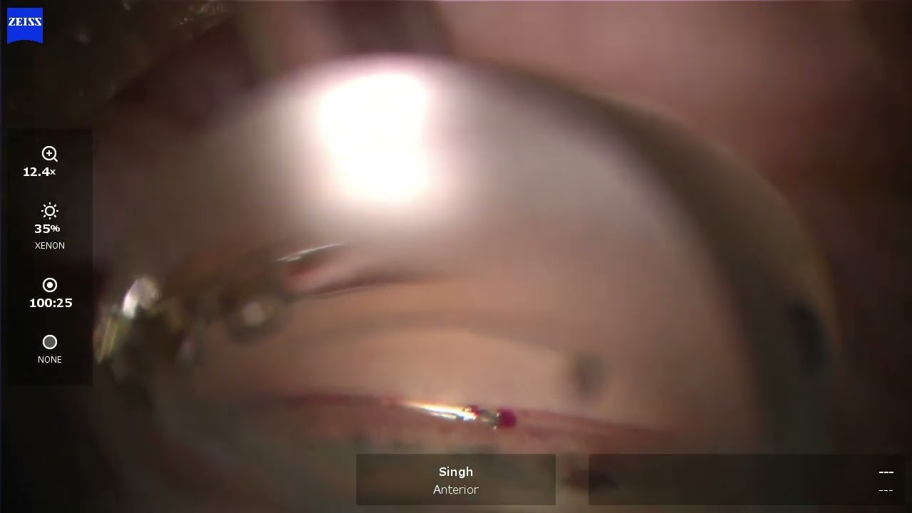 I Paul Singh-  Hydrus Microstent for Glaucoma - Adjustment and Blanching