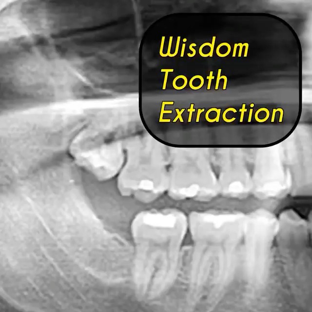 Upper Wisdom Tooth Extraction with my Spade and 77 R Elevators - YouTube