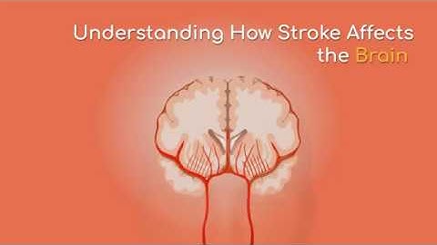 Understanding How Stroke Affects the Brain with Life Line Screening.