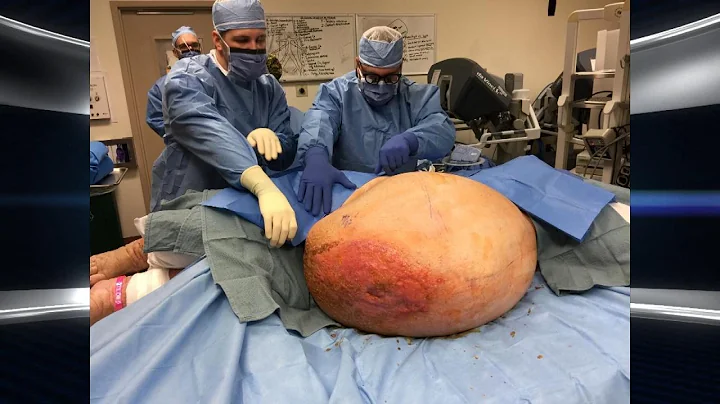 Woman's 140-Pound Tumor Removed