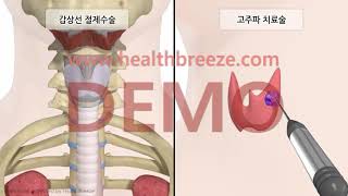 [시연용] c0075aako_갑상선 양성결절에 대한 고주파치료술 안내