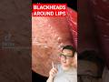 ❌YOUR LIP BALM IS CAUSING THIS - Blackhead Removal Around Lips #shorts