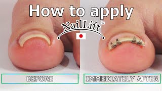 How to apply &quot;NailLift&quot; an ingrown toenail corrector / English v5