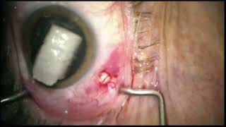 Jack Cioffi - CNTF Implantation