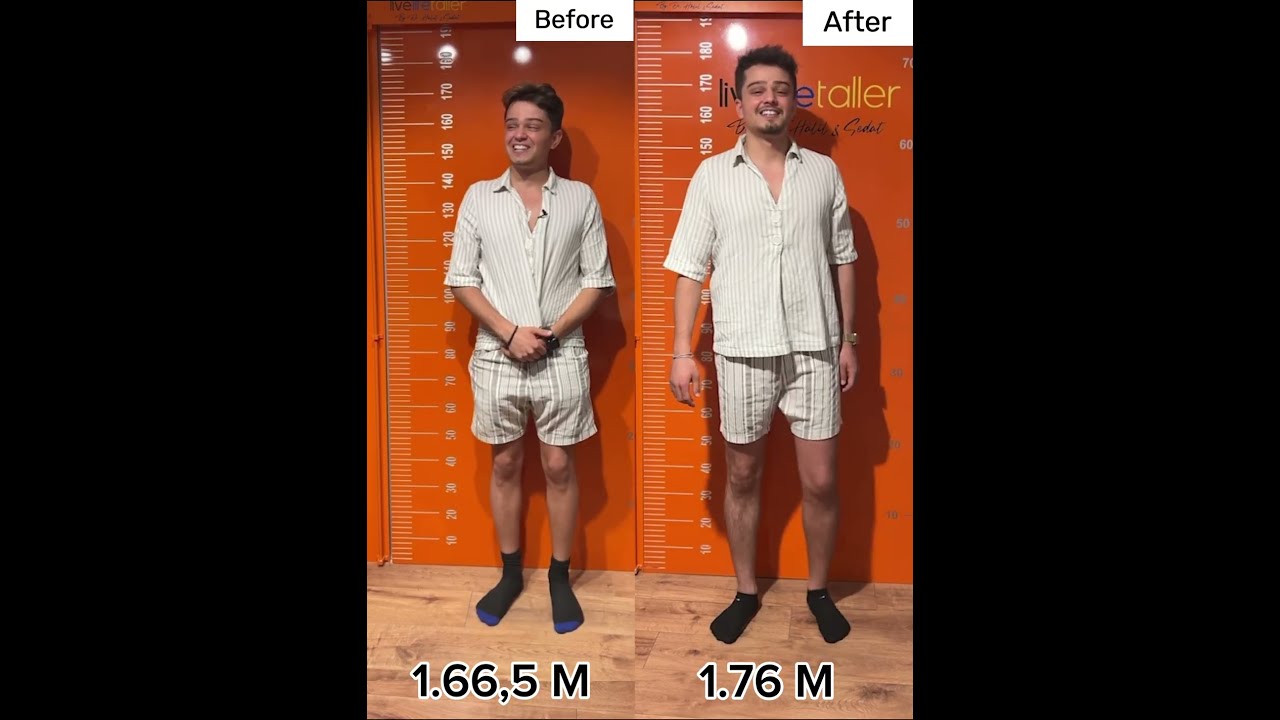 Before And After 9 5 Cm More Height Limblengthening Beforeafter Ozkansagin Gettaller Shorts