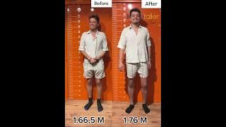 Before and after  9.5 cm more height #limblengthening #beforeafter #ozkansagin #gettaller #shorts