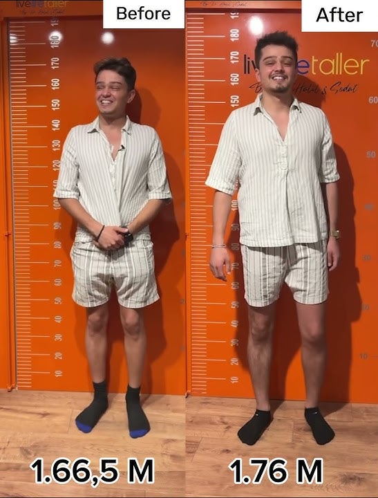 Before and after  9.5 cm more height #limblengthening #beforeafter #ozkansagin #gettaller #shorts
