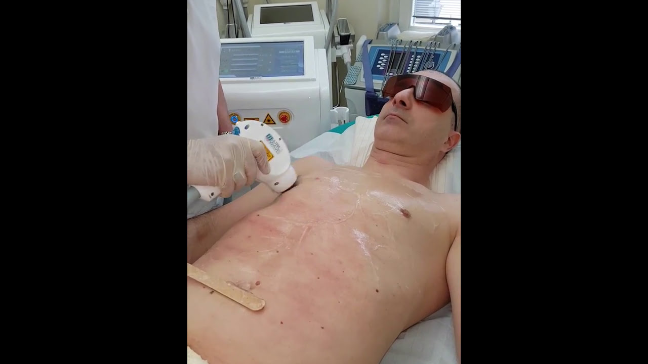 Dauerhafte Haarentfernung Garantiert ohne Schmerzen