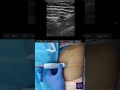 How To Scan For DSB Dual Subsartorial Block Ultrasound Regionalanesthesia Medical Nerveblock mp3