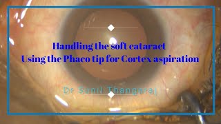 The soft cataract - easy phaco of prolapse and emulsify and cortex asp with phaco tip screenshot 1
