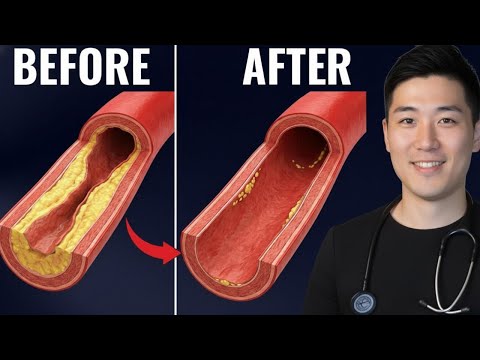 4 طرق علمية لتقليل تراكم اللويحات الشريانية ما هي الطرق الفعالة بالفعل