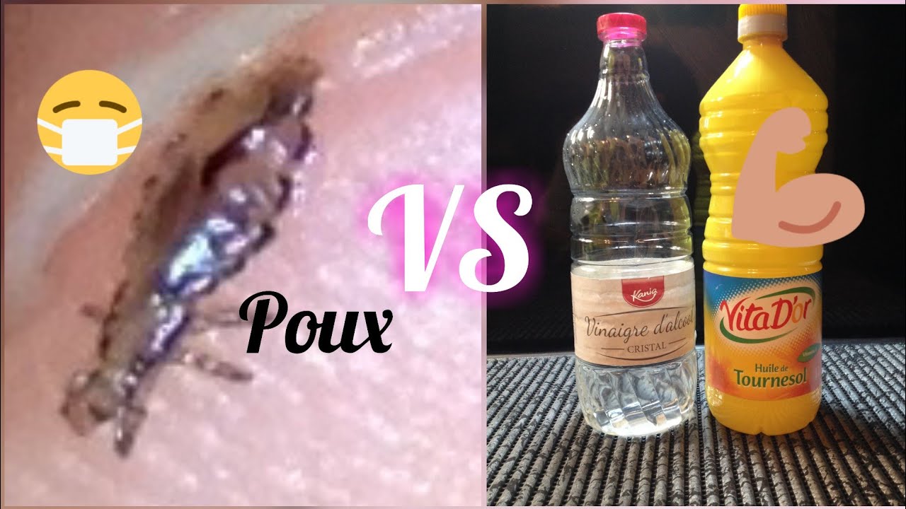 comment tuer les poux et les lentes